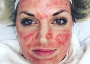 Θεραπεία του «Δράκουλα»: Η νέα μόδα που σαρώνει και … ανανεώνει το δέρμα