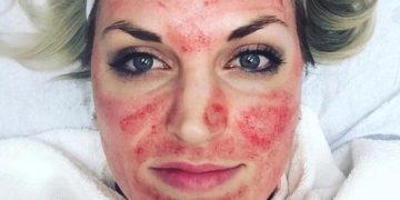 Alldaynews.gr Θεραπεία του «Δράκουλα»: Η νέα μόδα που σαρώνει και … ανανεώνει το δέρμα