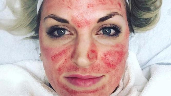 Alldaynews.gr Θεραπεία του «Δράκουλα»: Η νέα μόδα που σαρώνει και … ανανεώνει το δέρμα