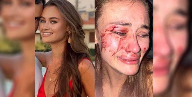 Alldaynews.gr Ουκρανή καλλονή καταγγέλλει: Με ξυλοκόπησαν άγρια στην Τουρκία (pics)