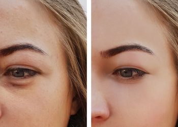 Σακούλες κάτω από τα μάτια: Πώς θα τις εξαφανίσετε