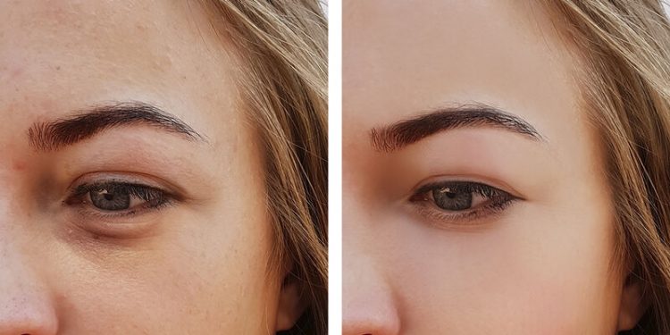 Alldaynews.gr Σακούλες κάτω από τα μάτια: Πώς θα τις εξαφανίσετε