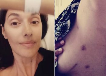 Νόνη Δούνια: Μας δείχνει τα σημάδια απο την επέμβαση καρδιάς ένα χρόνο μετά[photos]