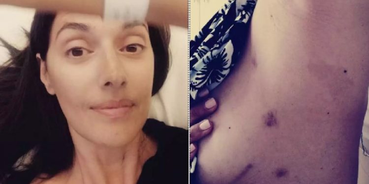 Νόνη Δούνια: Μας δείχνει τα σημάδια απο την επέμβαση καρδιάς ένα χρόνο μετά[photos]