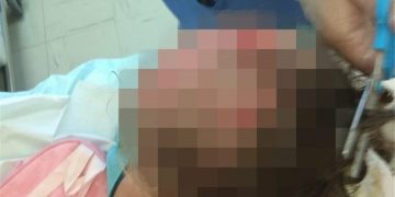 Alldaynews.gr επίθεση σε 3χρονο κοριτσάκι από πιτμπουλ