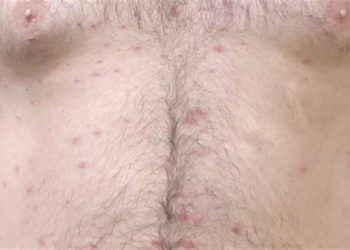 Κρήτη: Ένα ολόκληρο χωριό έπαθε αλλεργία! Φωτογραφίζονται και ζητούν απαντήσεις από ειδικούς (pics, vid)