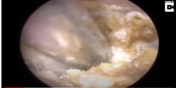 Το Αντέχεις;Γιατρός έβαλε κάμερα στο αυτί του ασθενή-Δες τι κατέγραψε![video]