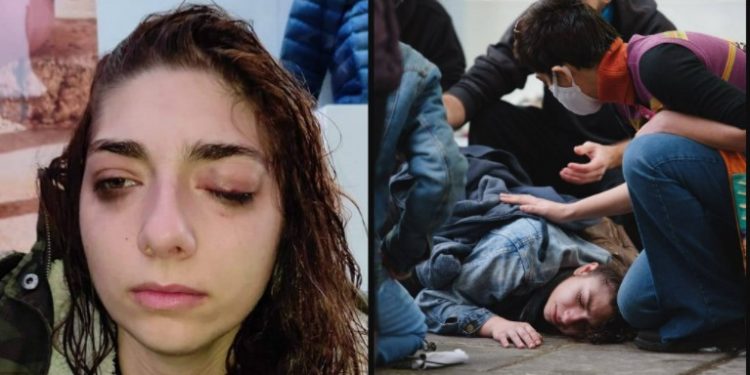 Alldaynews.gr Υποβάλλεται σε επέμβαση στο μάτι 25χρονη – «Είμαι η Αναστασία και έχω δεχτεί αστυνομική επίθεση γιατί χόρευα ειρηνικά στο πεζοδρόμιο»