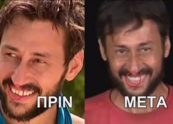Alldaynews.gr Survivor: Ο Πάνος Καλίδης έφτιαξε το ψεύτικο δόντι του στον Άγιο Δομίνικο-Το πριν και μετά!