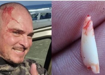 Δύτης βγάζει δόντι καρχαρία απο το κεφάλι του[video]