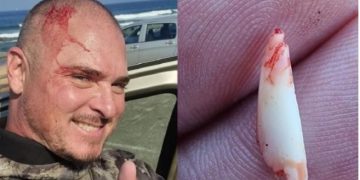 Δύτης βγάζει δόντι καρχαρία απο το κεφάλι του[video]