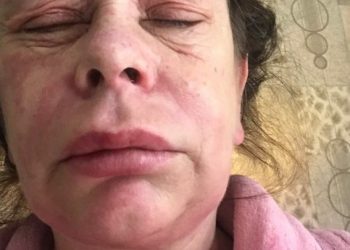 Γυναίκα που έκανε το εμβόλιο της AstraZeneca καταγγέλλει: «Μεταμορφώθηκα σε εξωγήινο τέρας»