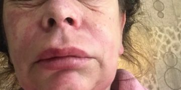 Alldaynews.gr Γυναίκα που έκανε το εμβόλιο της AstraZeneca καταγγέλλει: «Μεταμορφώθηκα σε εξωγήινο τέρας»