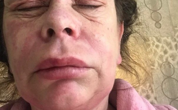 Alldaynews.gr Γυναίκα που έκανε το εμβόλιο της AstraZeneca καταγγέλλει: «Μεταμορφώθηκα σε εξωγήινο τέρας»