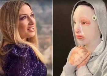 Επίθεση με βιτριόλι: «Το ένα αφτί της Ιωάννας έχει εξαφανιστεί – Πονάει στο φως»[video]