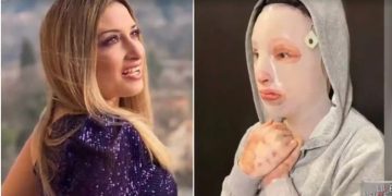 Επίθεση με βιτριόλι: «Το ένα αφτί της Ιωάννας έχει εξαφανιστεί – Πονάει στο φως»[video]