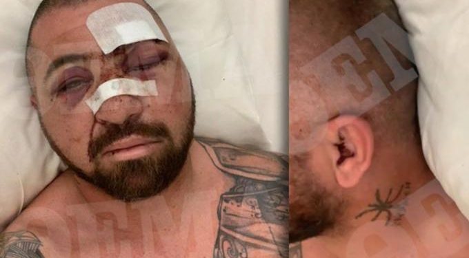 Σοκάρουν οι εικόνες του σωματοφύλακα του Μπιλζέριαν: «Eίμαι τυχερός που ζω» (vid)