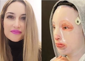 Επίθεση με βιτριόλι: Σε ειδική κλινική στη Γαλλία για θεραπείες η Ιωάννα