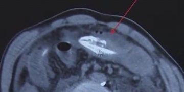 Έβαλε στον πρωκτό του χέλι 20 εκατοστών για να θεραπευτεί απο δυσκοιλιότητα και παραλίγο να πεθάνει