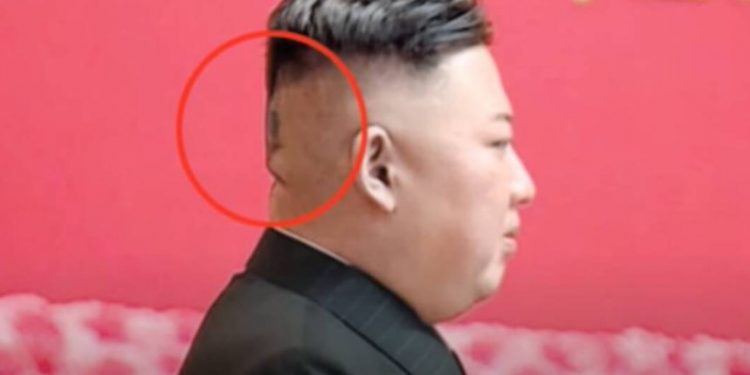 Β. Κορέα: «Μυστηριώδες» τσιρότο στο κεφάλι του Κιμ Γιονγκ Ουν πυροδοτεί νέες φήμες για την υγεία του[video]