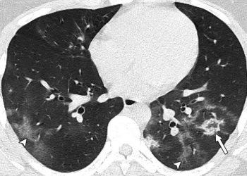 Μαγιορκίνης: Οι βλάβες στους πνεύμονες ανηλίκων με κορονοϊό -«Θέλετε να δείτε πόσα χρόνια θα χάσετε;»