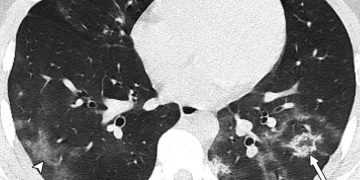 Μαγιορκίνης: Οι βλάβες στους πνεύμονες ανηλίκων με κορονοϊό -«Θέλετε να δείτε πόσα χρόνια θα χάσετε;»