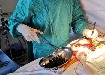 Ένα κιλό βίδες και καρφιά στο στομάχι ασθενούς – Πώς δικαιολόγησε ο ίδιος την κατάστασή του (Εικόνες)