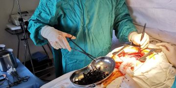 Alldaynews.gr Ένα κιλό βίδες και καρφιά στο στομάχι ασθενούς – Πώς δικαιολόγησε ο ίδιος την κατάστασή του (Εικόνες)