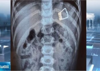 Τραγικό συμβάν στη Λήμνο: 2χρονο αγοράκι κατάπιε μανταλάκι-Πως το έσωσαν οι γιατροί