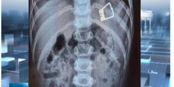 Τραγικό συμβάν στη Λήμνο: 2χρονο αγοράκι κατάπιε μανταλάκι-Πως το έσωσαν οι γιατροί