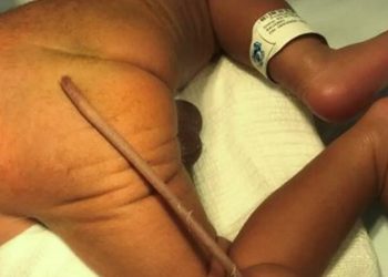 Πρόωρο μωράκι γεννήθηκε με ουρά 12 εκατοστά: Στην άκρη έχει παράξενη σάρκινη μπάλα[video]