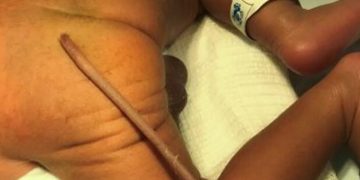 Πρόωρο μωράκι γεννήθηκε με ουρά 12 εκατοστά: Στην άκρη έχει παράξενη σάρκινη μπάλα[video]
