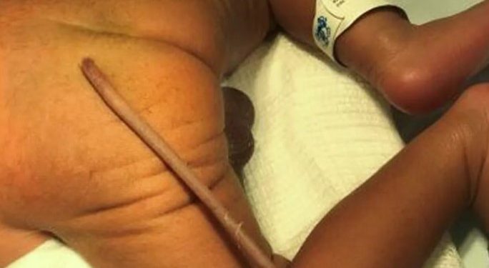 Πρόωρο μωράκι γεννήθηκε με ουρά 12 εκατοστά: Στην άκρη έχει παράξενη σάρκινη μπάλα[video]