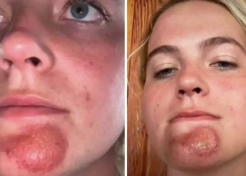 Κοπέλα «φασώθηκε» με τύπο με βρώμικα μούσια κι έπαθε απαίσια μόλυνση