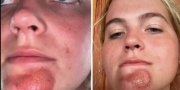 Κοπέλα «φασώθηκε» με τύπο με βρώμικα μούσια κι έπαθε απαίσια μόλυνση