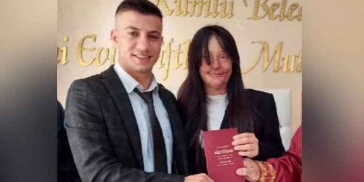 Alldaynews.gr Ξέσπασε Σάλος: 20χρονη παντρεύτηκε τον άνδρα που την παραμόρφωσε με οξύ