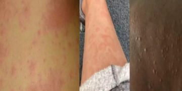 Κορονοϊός-Μετάλλαξη Όμικρον: Αυτά είναι τα εξανθήματα που προκαλεί