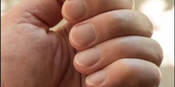 Στα νύχια φαίνονται σημαντικά προβλήματα υγείας: Τι θα προσέξετε αν σας συμβεί[photos]
