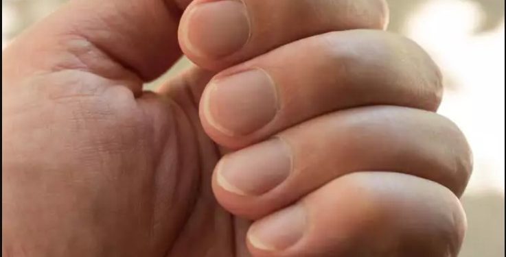 Στα νύχια φαίνονται σημαντικά προβλήματα υγείας: Τι θα προσέξετε αν σας συμβεί[photos]