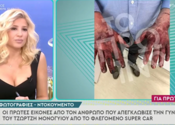 Σοκάρουν τα εγκαύματα στα χέρια του ανθρώπου που απεγκλώβισε τη σύζυγο του Μονογυιού (video)