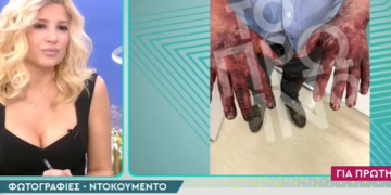 Alldaynews.gr Σοκάρουν τα εγκαύματα στα χέρια του ανθρώπου που απεγκλώβισε τη σύζυγο του Μονογυιού (video)