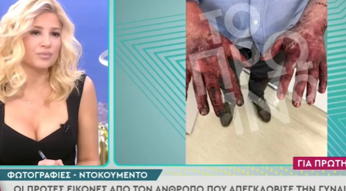 Alldaynews.gr Σοκάρουν τα εγκαύματα στα χέρια του ανθρώπου που απεγκλώβισε τη σύζυγο του Μονογυιού (video)