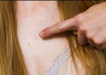 Μελάνωμα: Τι πρέπει να ξέρουν ειδικά οι γυναίκες γι’ αυτόν τον καρκίνο του δέρματος