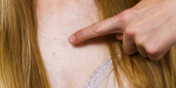 Alldaynews.gr Μελάνωμα: Τι πρέπει να ξέρουν ειδικά οι γυναίκες γι’ αυτόν τον καρκίνο του δέρματος