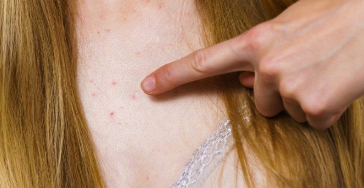Alldaynews.gr Μελάνωμα: Τι πρέπει να ξέρουν ειδικά οι γυναίκες γι’ αυτόν τον καρκίνο του δέρματος