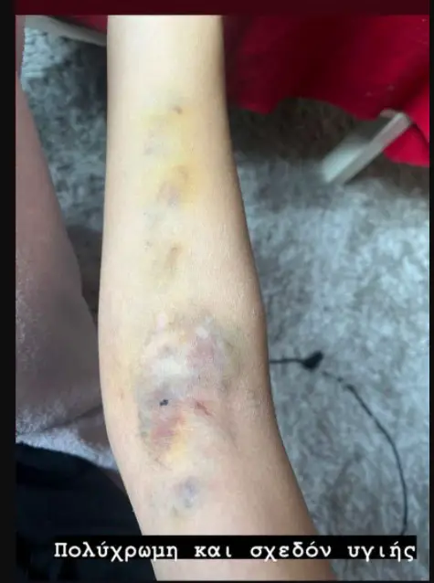 Μαρία Μιχαλοπούλου: Σοκάρουν οι εικόνες: Τα αποτελέσματα από τις θεραπείες στο αιμαγγείωμα του χεριού της[photos]