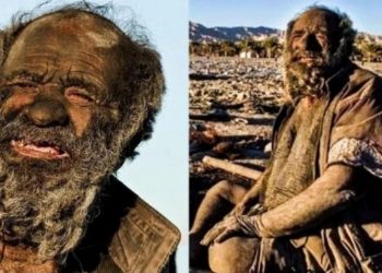 70 χρόνια χωρίς μπάνιο: O πιο βρώμικος άνθρωπος του κόσμου άφησε έκπληκτους τους γιατρούς που τον εξέτασαν[video]