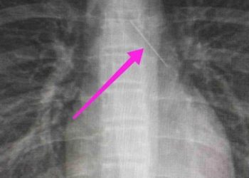 Θεσσαλονίκη: Ανήλικη κατάπιε καρφίτσα – Είχε σταθεί στον δεξιό βρόγχο