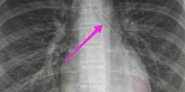 Alldaynews.gr Θεσσαλονίκη: Ανήλικη κατάπιε καρφίτσα – Είχε σταθεί στον δεξιό βρόγχο