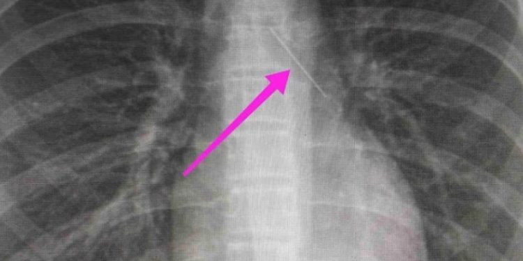 Alldaynews.gr Θεσσαλονίκη: Ανήλικη κατάπιε καρφίτσα – Είχε σταθεί στον δεξιό βρόγχο